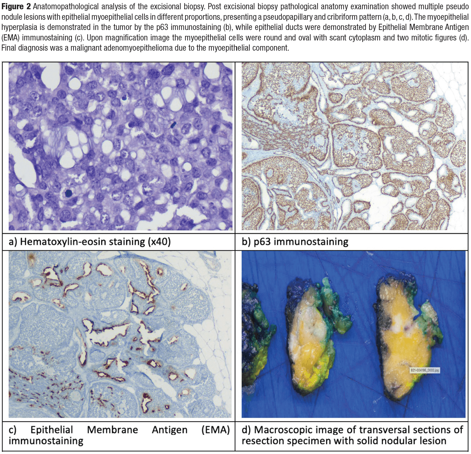 Malignant adenomyoepithelioma of the breast a case report and review