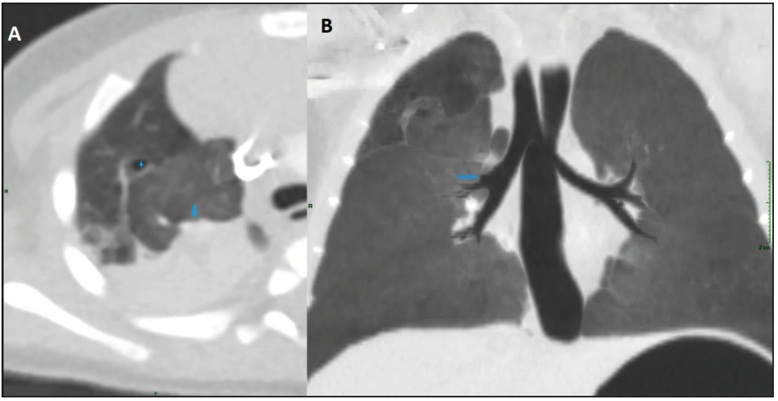 Challenging antenatal differential diagnosis of a congenital lung ...