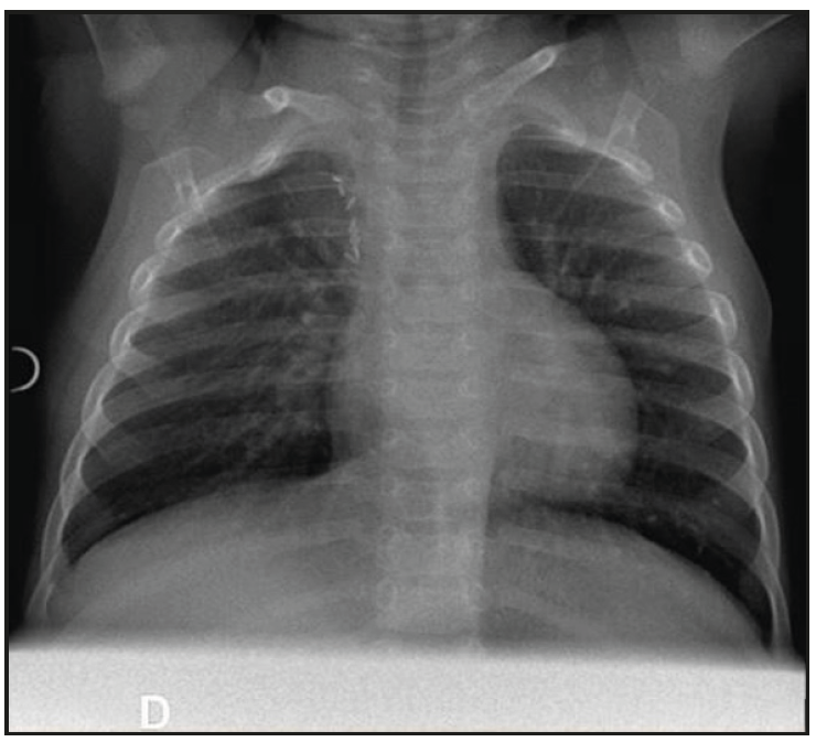 Challenging antenatal differential diagnosis of a congenital lung ...